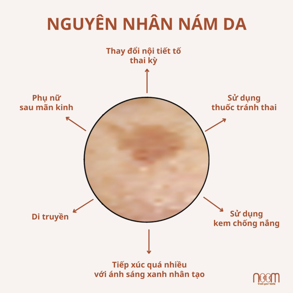 Cách Trị Nám Da Mặt Bằng Thiên Nhiên 2 Nguyên nhân gây nám da