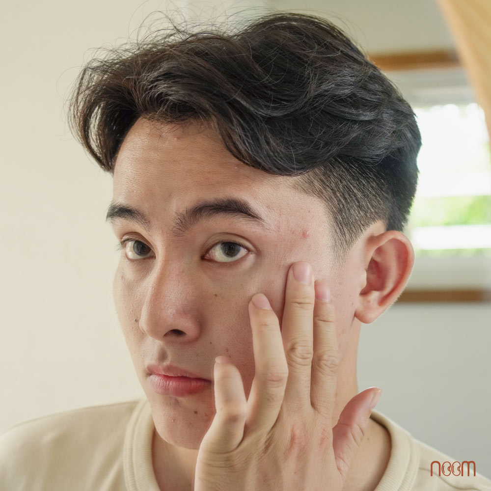 cach tri mụn