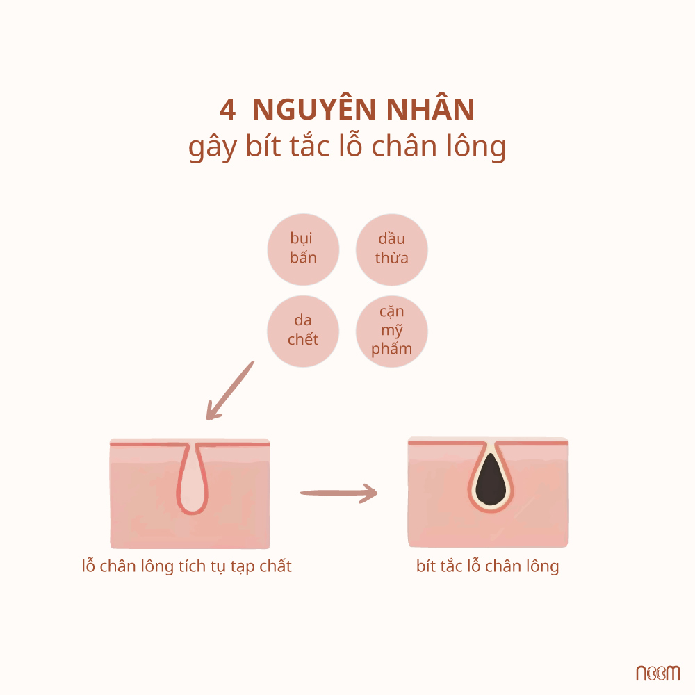 Lỗ Chân Lông To Bít Tắc – Càng Nên Oil Skincare 1 lỗ chân lông to